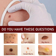 Warts Remover