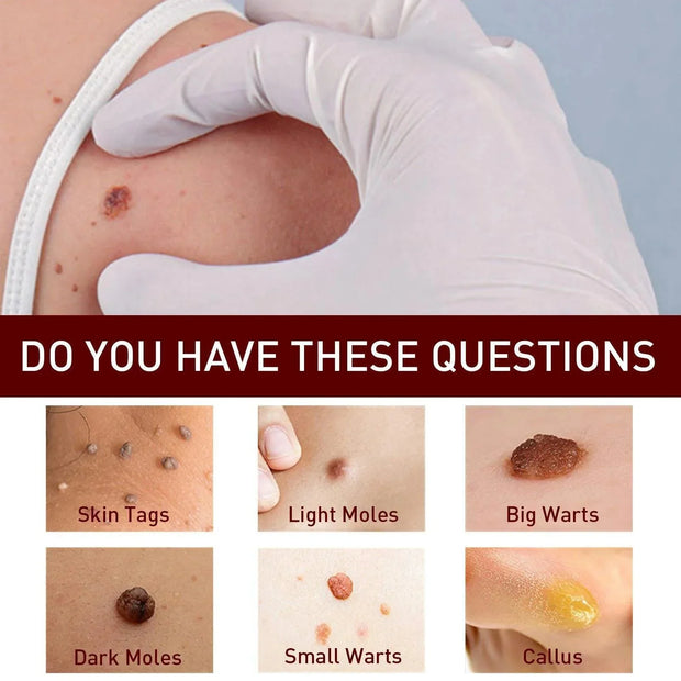 Warts Remover
